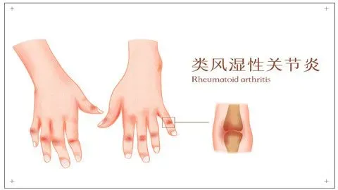类风湿吃什么药最有效,类风湿性关节炎吃什么药疗效最好呢？
