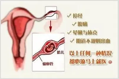 宫外孕一般多少天能发现？宫外孕的三大症状 | 妙招大全