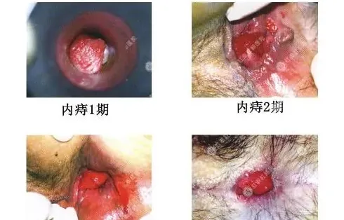 什么是痔疮,痔疮是什么？