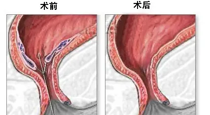 长痔疮会自然好吗,痔疮会自己好吗？