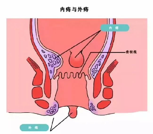 痔疮出血了该怎么办,痔疮犯了出血怎么办？