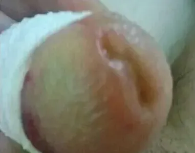 小儿阴茎包皮水肿究竟是怎么回事呢？ 包皮水肿可用中草药外洗 | 常识大全