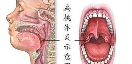 对化脓性扁桃体炎可别大意 | 妙招大全
