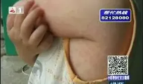 夏天皮肤病的防治 | 妙招大全