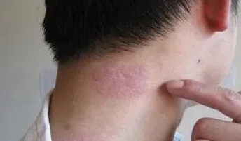 牛皮癣会不会传染给别人 | 常识大全