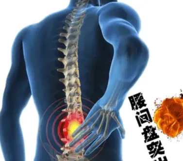 曼陀罗可以治腰椎间盘突出吗,曼陀罗花专治什么病？