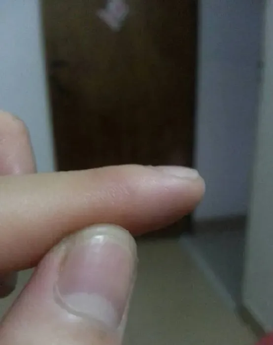 狗狗牙齿划破轻微出血,狗不听话.昨晚打了他一巴掌.不小心在他牙齿上把手碰烂了米粒大的伤口流血了.用打狂犬疫苗吗?狗狗现在？
