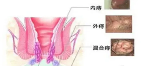 如何缓解痔疮,痔疮怎样缓解？