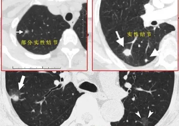 中医可以消除肺结节吗,省中省院专治肺结节药䯧医保报销吗？