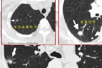 中医可以消除肺结节吗