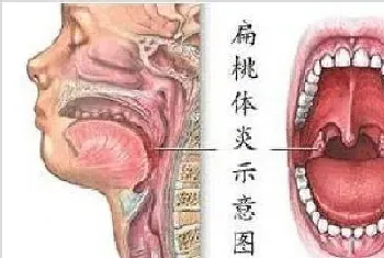 对化脓性扁桃体炎可别大意