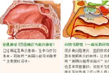 怎么判断鼻炎和鼻窦炎